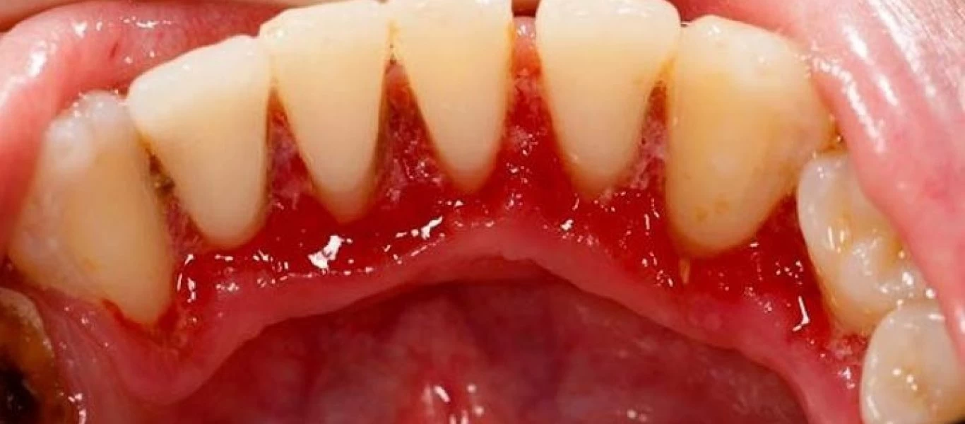 Σημάδι διαβήτη τύπου 2 αν δείτε αυτό στα ούλα σας